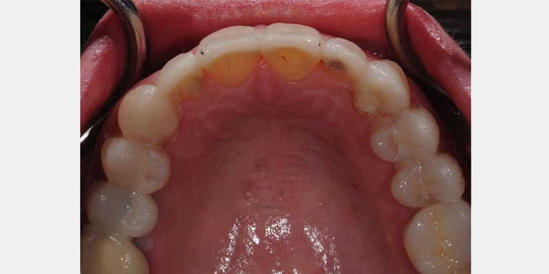 Carillas dentales: las filtraciones silenciosas que pueden arruinarte la sonrisa sin que te des cuenta